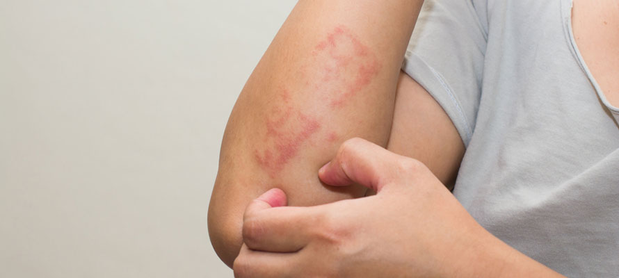 Uncovering the Link Between Eczema and Autoimmune Conditions