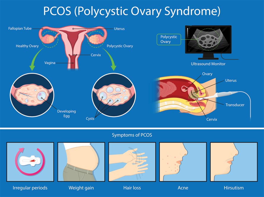 Polycystic Ovarian Syndrome
