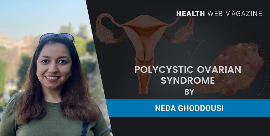 PCOS: Symptoms, Causes, Diagnosis And Treatments