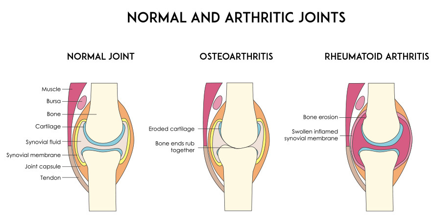 Why Joint Pain Occurs – Inflammation and Swelling Explained for How to Sit With SI Joint Pain
